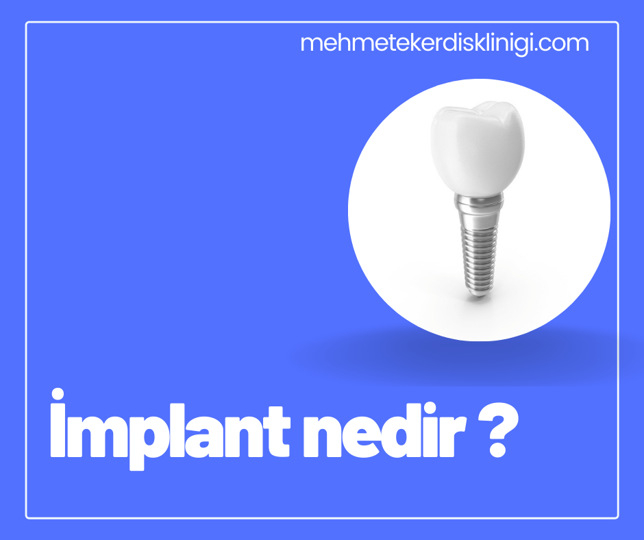 İmplant Nedir? 2024 İmplant Fiyatları Ne Kadar?
