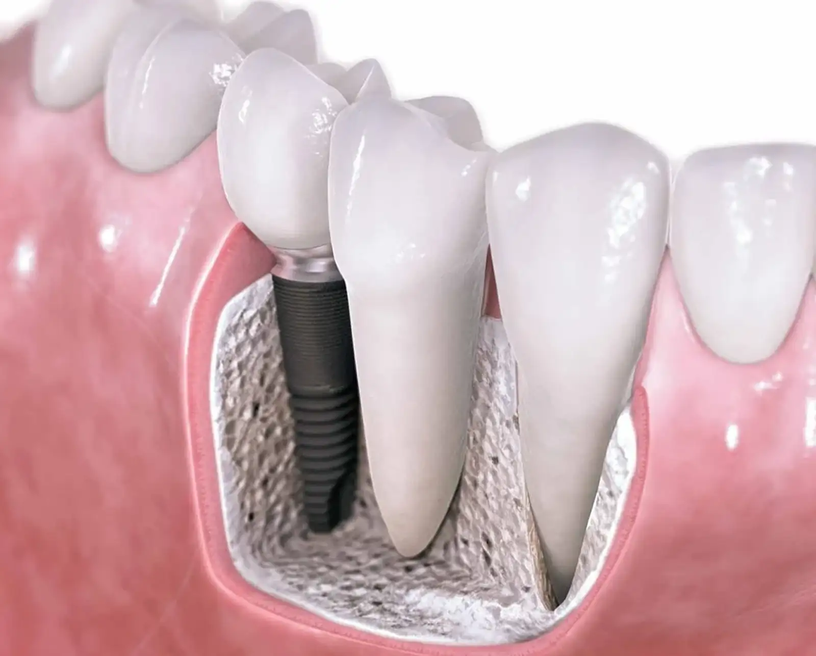 Implant Çene Kemiğine Zarar Verir mi?