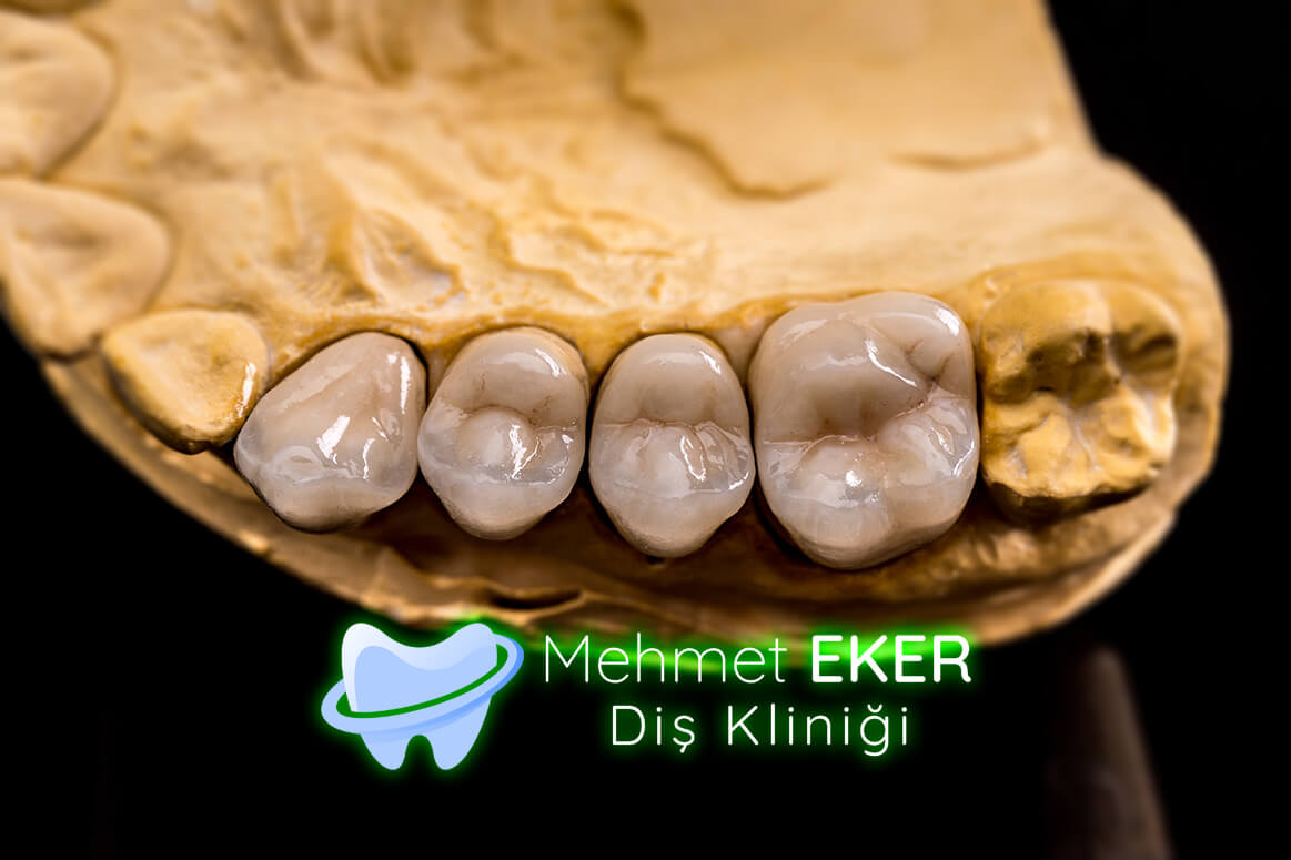 Porselen Diş Kırılır mı?