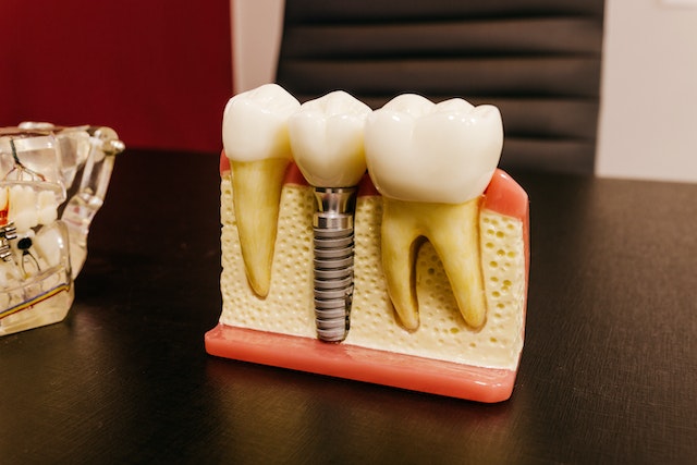 tum-disler-implant-olur-mu
