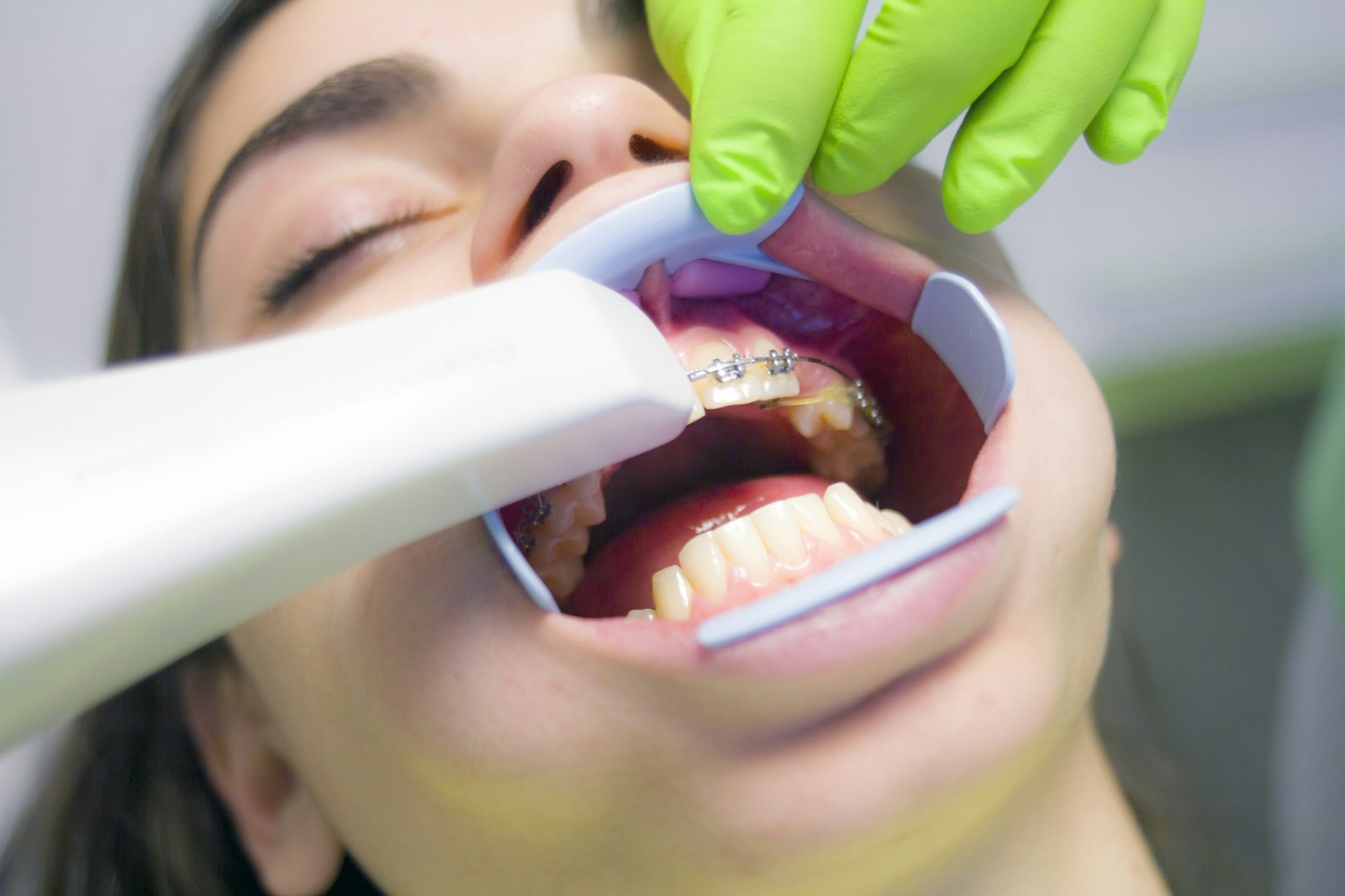 Braket Nedir? Braket Kırılması ile Baş Etme Yolları