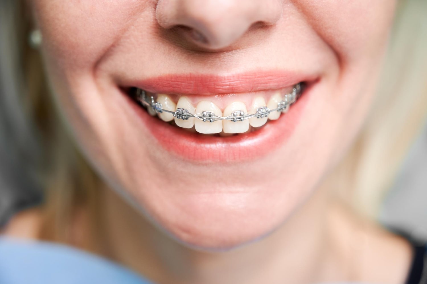 Güncel Ortodonti Tedavileri Hangileri? 5 Ortodonti Yöntemi