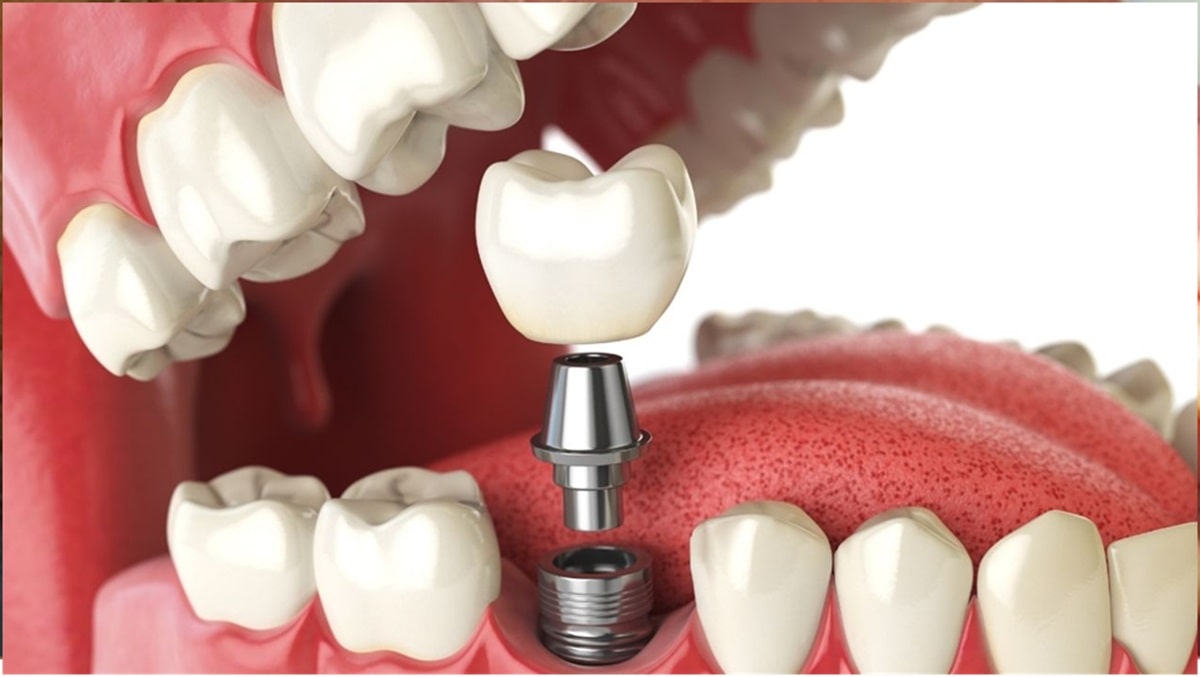 adim-adim-implant-asamalari-resimli
