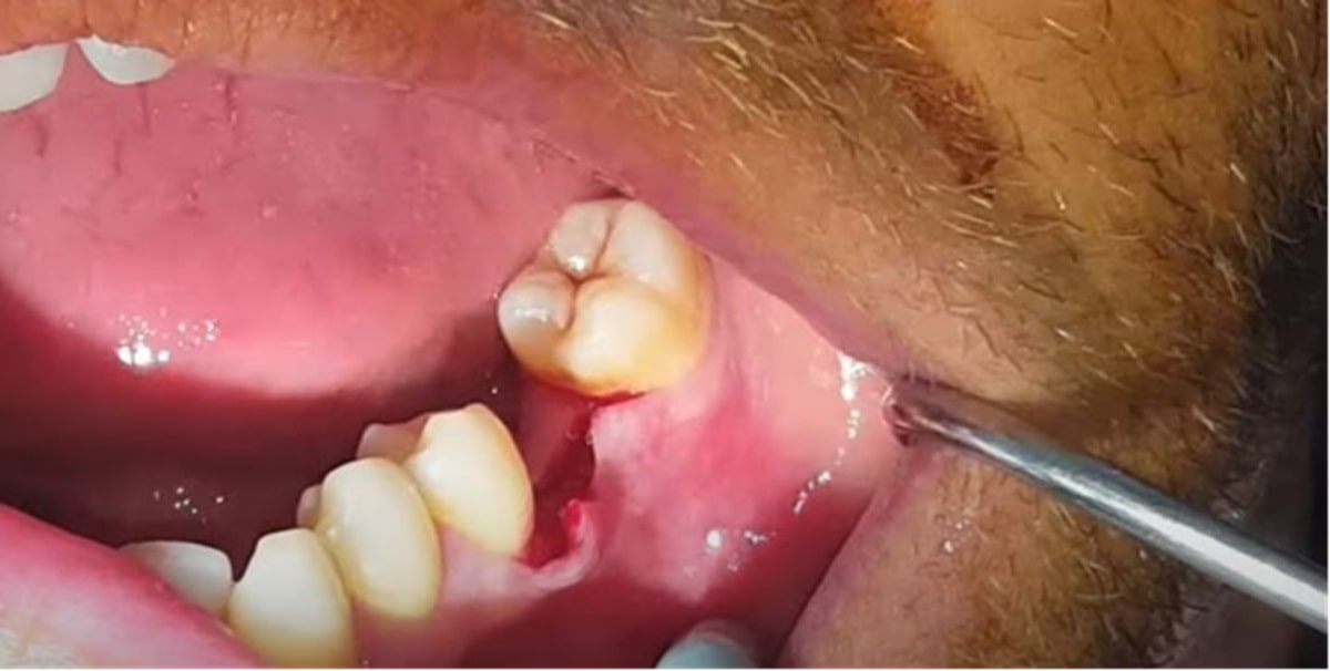 adim-adim-implant-asamalari-resimli