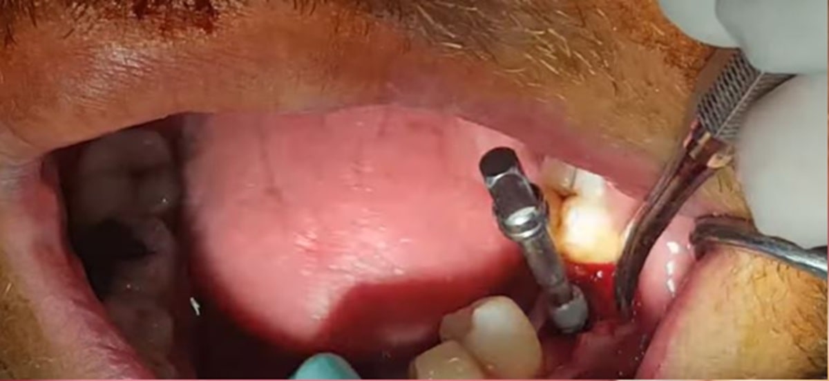 adim-adim-implant-asamalari-resimli