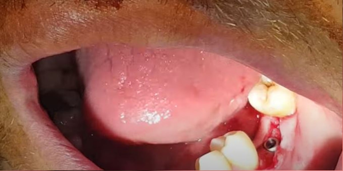 adim-adim-implant-asamalari-resimli