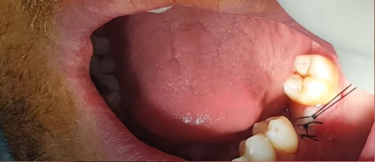 adim-adim-implant-asamalari-resimli