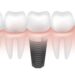 adim-adim-implant-asamalari-resimli