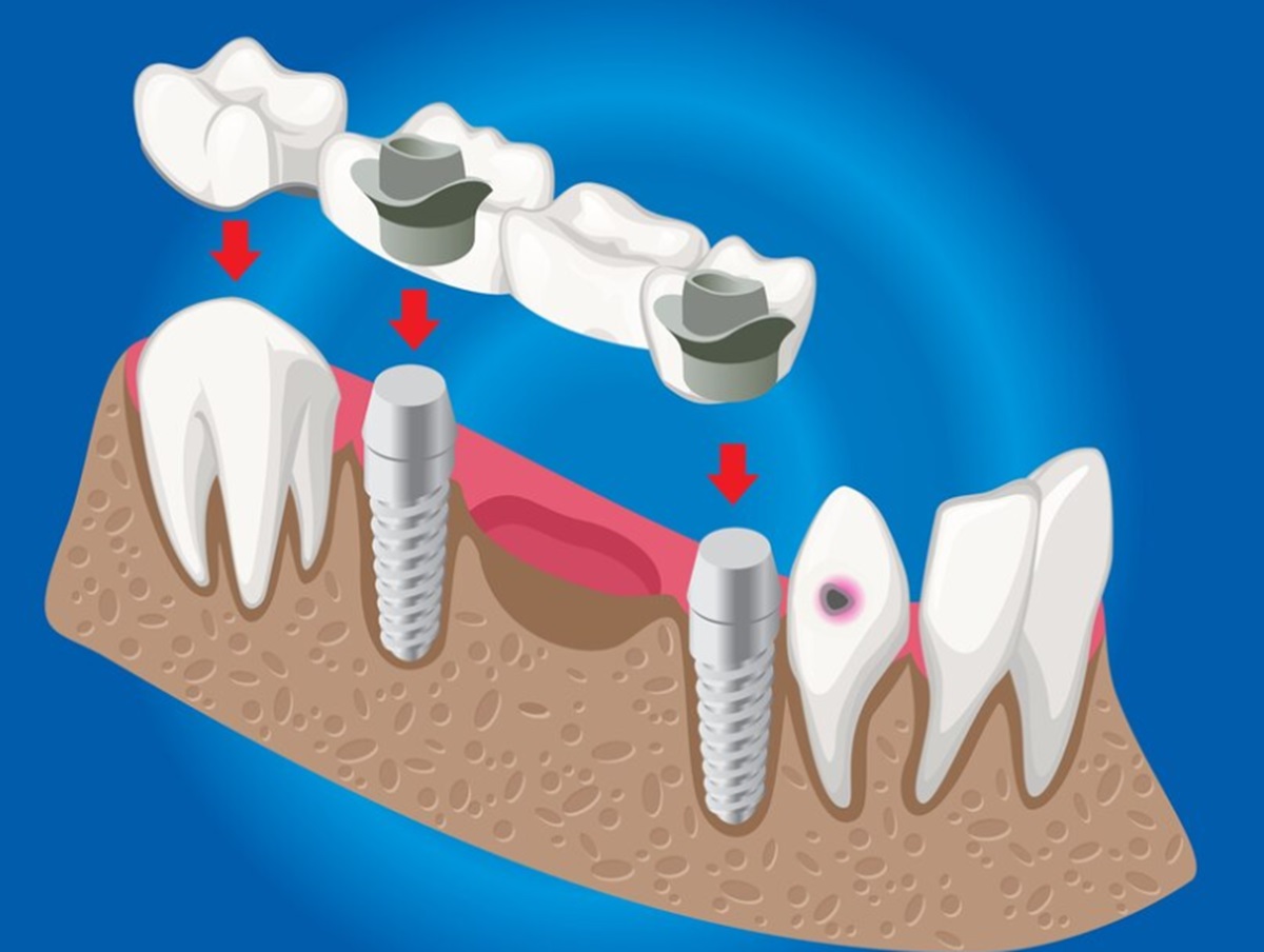 basarisiz-implant-belirtileri-nelerdir-