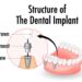 dentis-implant-markasi-nedir-