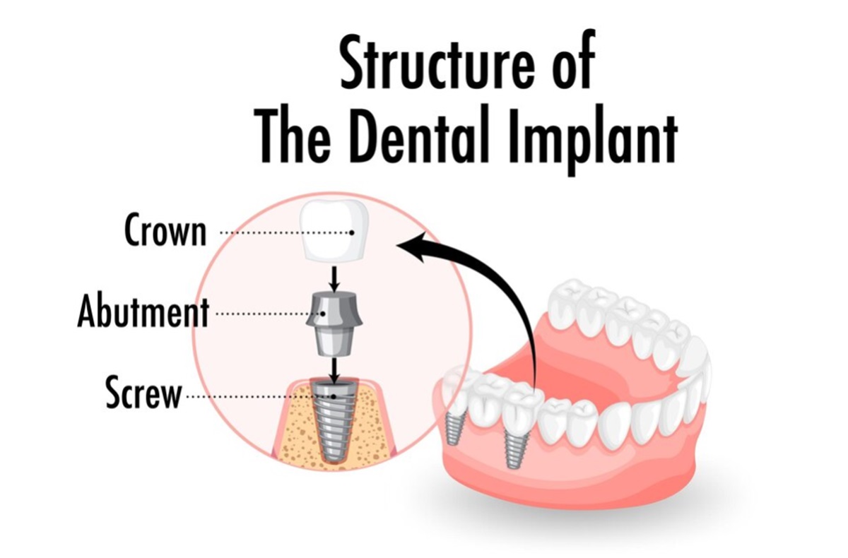 Dentis İmplant Markası Nedir?