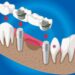 en-iyi-implant-markalari-