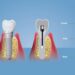 implant-sonrasi-nelere-dikkat-edilmeli-