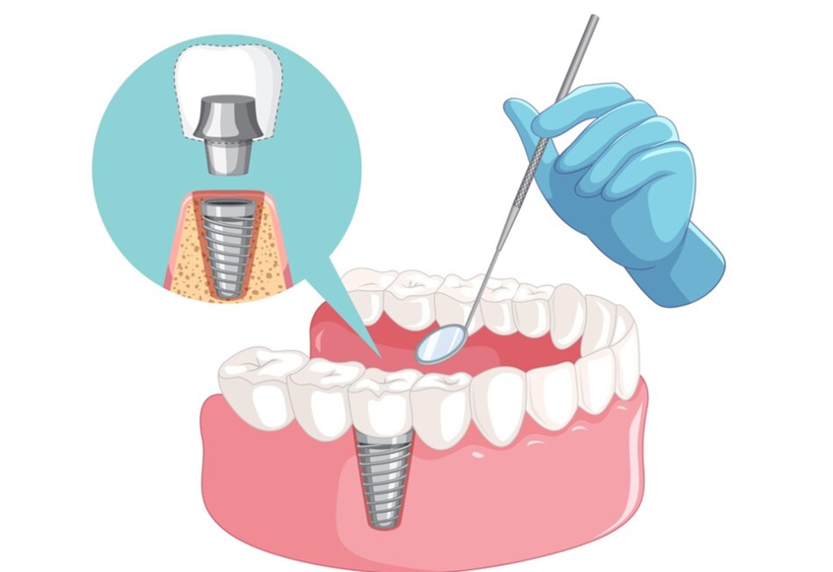 İmplant Vidası Takıldıktan Sonra Diş Ne Zaman Takılır? Ne Kadar Süre Geçmeli?