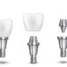 kirilmis-alana-dis-implant-nasil-yapilir