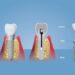 implant-vidasi-gorunur-mu-