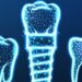 1-implant-kac-dis-tutar
